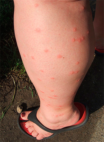 Kleine rote Punkte am Bein - zahlreiche Flohbisse.