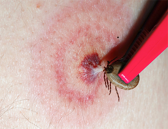 Eine solche Bissspur in Form konzentrischer roter Ringe ist in der Regel ein Zeichen für eine Infektion der Zecke. Daher sollte umgehend ein Krankenhaus für eine Beratung und Behandlung aufgesucht werden.