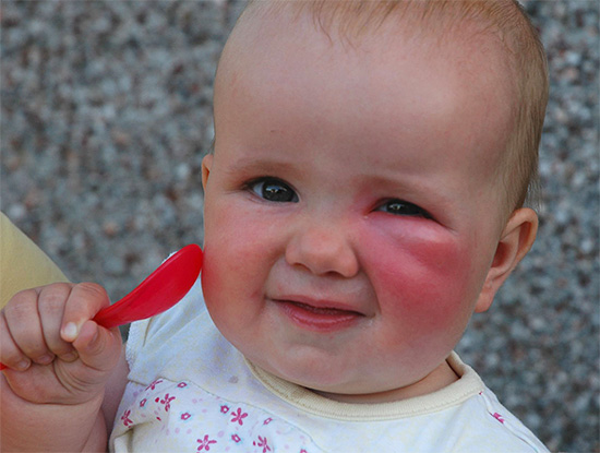 Bei kleinen Kindern können Bisse selbst von scheinbar harmlosen Insekten ohne Behandlung manchmal eine gefährliche Form annehmen.