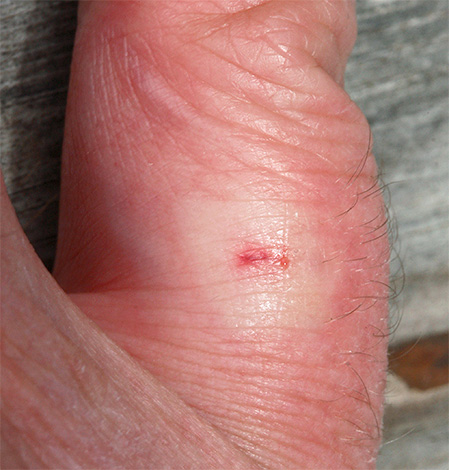 Wespenstich am Finger