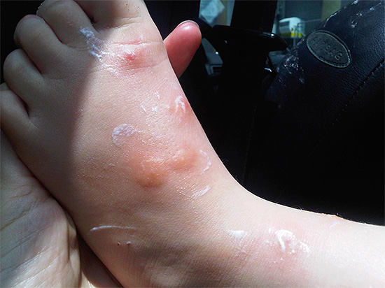 So sehen Wanzenbisse am Bein eines Kindes aus (bereits mit Heilsalbe behandelt).