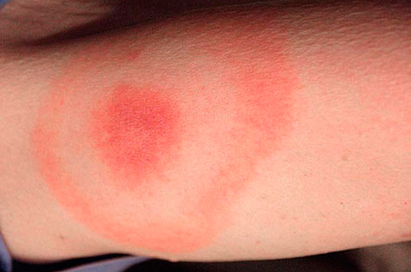 Konzentrische rote Ringe um die Zeckenbissstelle deuten auf eine Infektion mit Lyme-Borreliose hin. Konzentrische rote Ringe um die Zeckenbissstelle deuten auf eine Infektion mit Lyme-Borreliose hin.
