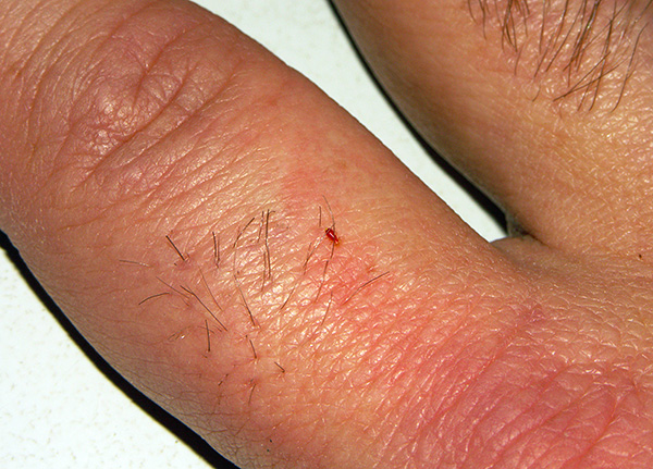 Die Larve der Bettwanze saugt Blut. Die Larve der Bettwanze saugt Blut.
