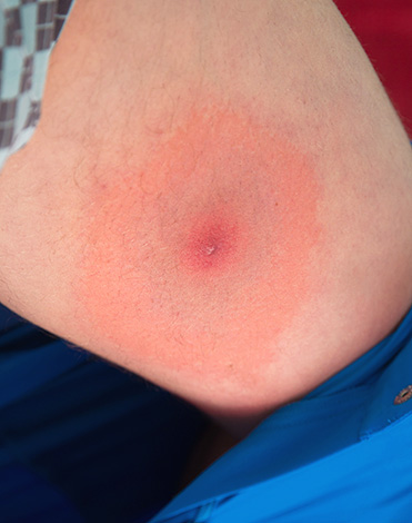 So sieht ein Biss einer Borreliose-Zecke in der Regel aus. So sieht ein Biss einer Borreliose-Zecke in der Regel aus.