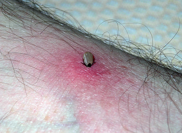 Die Bakterien gelangen zusammen mit dem Speichel des Parasiten in die Wunde, und zwar umso mehr, je länger der Stich dauert. Die Bakterien gelangen zusammen mit dem Speichel des Parasiten in die Wunde, und zwar umso mehr, je länger der Stich dauert.