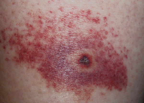 Eine antiseptische Behandlung der Bissstelle schützt nicht vor Frühsommer-Meningoenzephalitis oder Borreliose, verringert aber das Risiko einer Sekundärinfektion. Eine antiseptische Behandlung der Bissstelle schützt nicht vor Frühsommer-Meningoenzephalitis oder Borreliose, verringert aber das Risiko einer Sekundärinfektion.