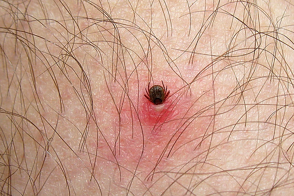 Bei der Notfallversorgung einer von einem Zeckenstich betroffenen Person ist es wichtig, Fehler zu vermeiden, um die Situation nicht zu verschlimmern. Bei der Notfallversorgung einer von einem Zeckenstich betroffenen Person ist es wichtig, Fehler zu vermeiden, um die Situation nicht zu verschlimmern.
