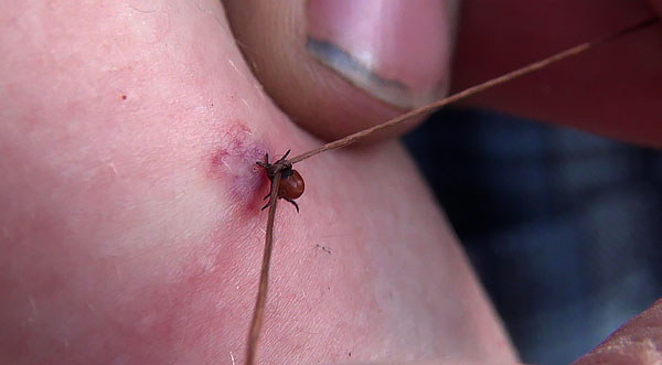 Beispiel für die Entfernung eines festgesaugten Parasiten mit einem Faden. Beispiel für die Entfernung eines festgesaugten Parasiten mit einem Faden.