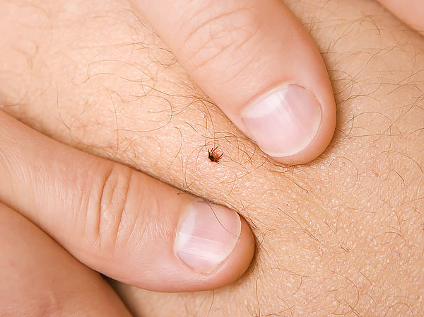 Eine so kleine Zecke ist mit den Fingern sehr schwer richtig zu greifen, besonders wenn die Fingernägel kurz geschnitten sind. Eine so kleine Zecke ist mit den Fingern sehr schwer richtig zu greifen, besonders wenn die Fingernägel kurz geschnitten sind.