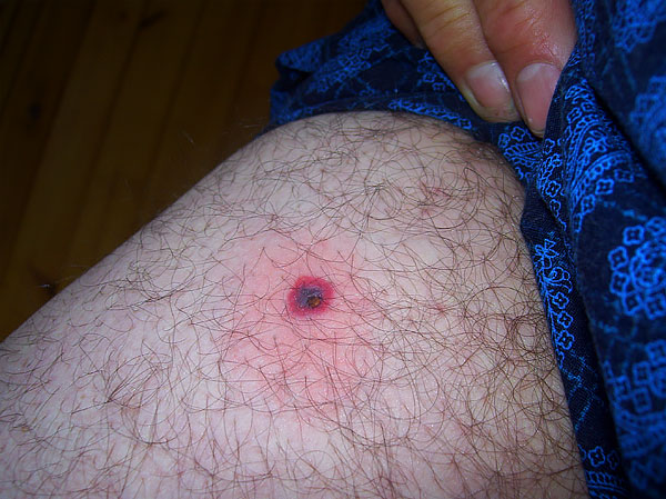 Wenn der Kopf des Parasiten abgerissen ist, muss er mit einer Nadel angehoben und wie ein Splitter aus der Haut entfernt werden. Wenn der Kopf des Parasiten abgerissen ist, muss er mit einer Nadel angehoben und wie ein Splitter aus der Haut entfernt werden.