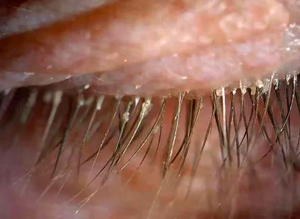 Ein charakteristisches Symptom der Demodikose sind Sekretabsonderungen an den Wimpern. Ein charakteristisches Symptom der Demodikose sind Sekretabsonderungen an den Wimpern.