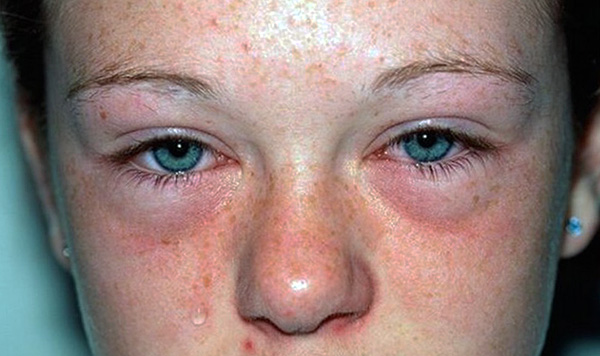 Anzeichen einer Milbenallergie können ständiger Juckreiz der Haut, Niesen und Tränenfluss sein, die sich beim Aufenthalt im Haus verstärken. Anzeichen einer Milbenallergie können ständiger Juckreiz der Haut, Niesen und Tränenfluss sein, die sich beim Aufenthalt im Haus verstärken.