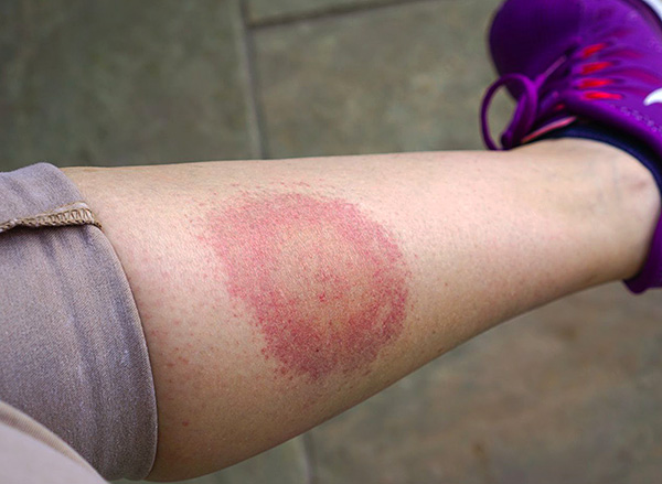 Die wandernde (Ring-)Rötung ist ein charakteristisches Anzeichen der Lyme-Borreliose.