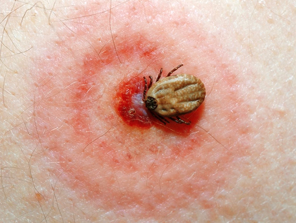Ein charakteristischer roter Kreis aus mehreren Ringen um die Bissstelle ist eines der deutlichen Anzeichen für eine Zecken-Borreliose. Ein charakteristischer roter Kreis aus mehreren Ringen um die Bissstelle ist eines der deutlichen Anzeichen für eine Zecken-Borreliose.