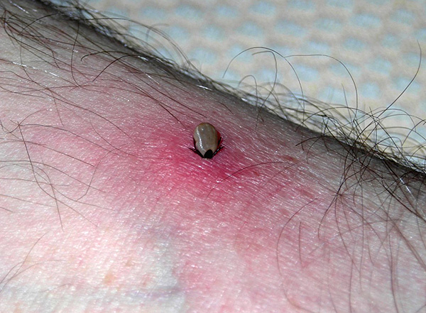 Je länger die Zecke Blut saugt, desto höher ist das Risiko einer Übertragung der Infektion (sofern der Parasit deren Überträger ist). Je länger die Zecke Blut saugt, desto höher ist das Risiko einer Übertragung der Infektion (sofern der Parasit deren Überträger ist).