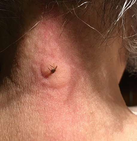 In manchen Fällen entwickelt sich als Reaktion auf einen Zeckenstich eine ausgeprägte allergische Reaktion. In manchen Fällen entwickelt sich als Reaktion auf einen Zeckenstich eine ausgeprägte allergische Reaktion.