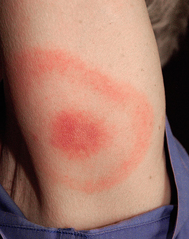 Wanderröte (Erythema migrans). Wanderröte (Erythema migrans).