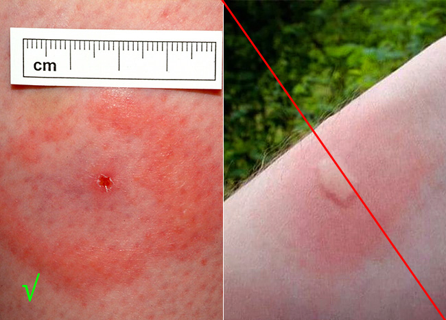 Links ist die Spur eines Zeckenstichs zu sehen, rechts die eines Mückenstichs. Links ist die Spur eines Zeckenstichs zu sehen, rechts die eines Mückenstichs.