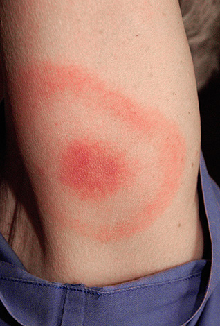 So sieht ein Erythema migrans aus – ein Anzeichen für eine Infektion mit der Lyme-Borreliose. So sieht ein Erythema migrans aus – ein Anzeichen für eine Infektion mit der Lyme-Borreliose.