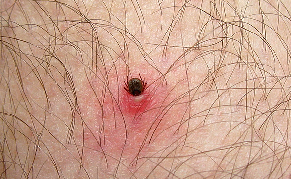 Beim Stich kann der Parasit seinen Kopf tief in die Haut eintauchen. Beim Stich kann der Parasit seinen Kopf tief in die Haut eintauchen.