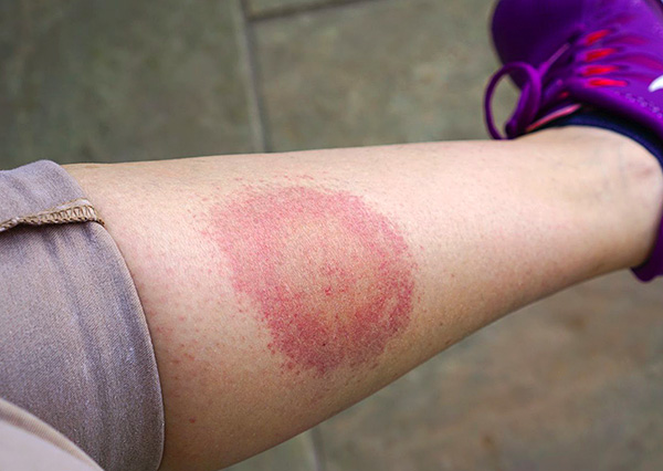 Ein weiteres Beispiel dafür, wie ein Biss einer Borreliose-Zecke aussehen kann. Ein weiteres Beispiel dafür, wie ein Biss einer Borreliose-Zecke aussehen kann.