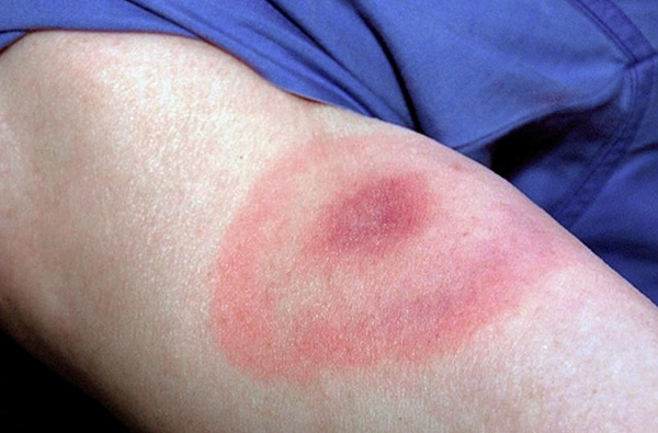 So sieht ein Erythema chronicum migrans aus – ein Zeichen einer Infektion mit Lyme-Borreliose. So sieht ein Erythema chronicum migrans aus – ein Zeichen einer Infektion mit Lyme-Borreliose.