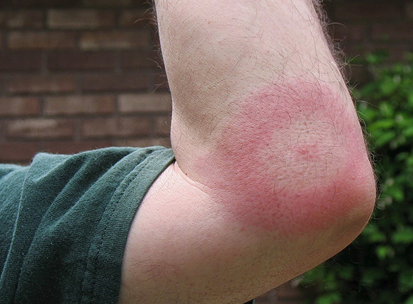 Ein solcher Ring kann allmählich an Durchmesser zunehmen. Ein solcher Ring kann allmählich an Durchmesser zunehmen.