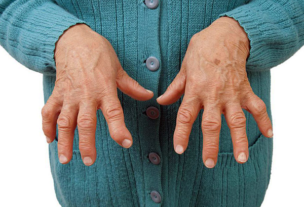 Folgen einer Arthritis Folgen einer Arthritis