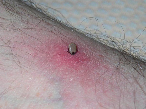 Je länger der Parasit Blut trinkt, desto höher ist die Wahrscheinlichkeit, sich mit einer von Zecken übertragenen Infektion anzustecken.