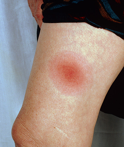 Ein weiteres Beispiel eines Erythema chronicum migrans auf der menschlichen Haut Ein weiteres Beispiel eines Erythema chronicum migrans auf der menschlichen Haut
