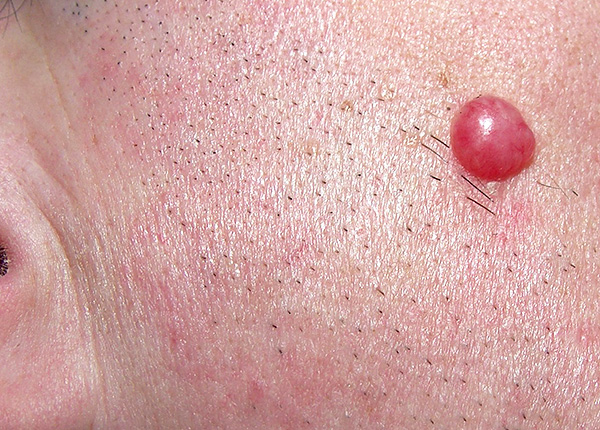 Gutartiges Lymphozytom der Haut - ein Zeichen der Lyme-Borreliose Gutartiges Lymphozytom der Haut - ein Zeichen der Lyme-Borreliose