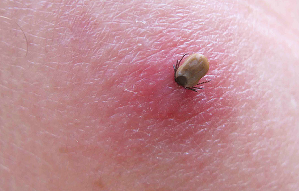 Schildzecke (Ixodes), die auf der Haut eines Menschen saugt Schildzecke (Ixodes), die auf der Haut eines Menschen saugt