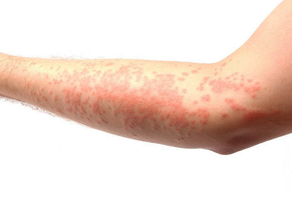 Bei Kontakt des Mittels mit der Haut kann eine allergische Reaktion auftreten. Daher sollte die erste Anwendung des Präparats mit Vorsicht erfolgen. Bei Kontakt des Mittels mit der Haut kann eine allergische Reaktion auftreten. Daher sollte die erste Anwendung des Präparats mit Vorsicht erfolgen.