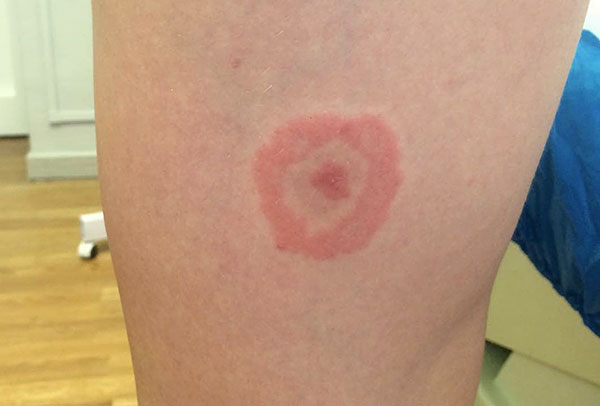 Roter Ring um die Zeckenstichstelle