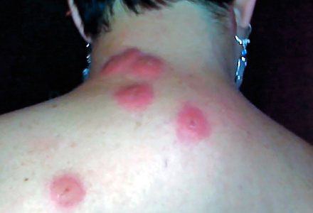 Allergie à une piqûre de punaise Allergie à une piqûre de punaise