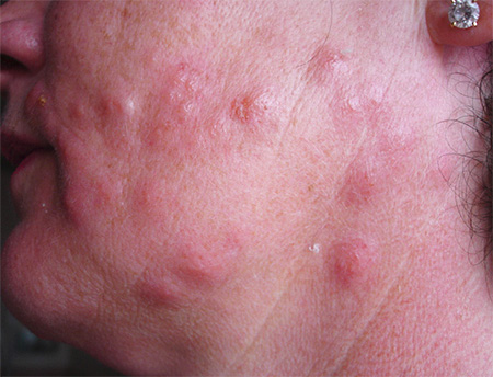 Gonflements dus aux piqûres de punaises sur le visage Gonflements dus aux piqûres de punaises