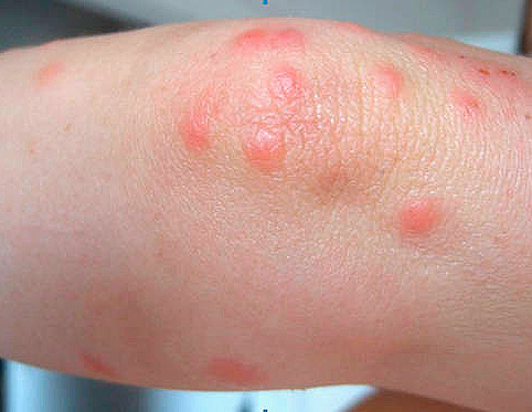 Gonflements caractéristiques dus aux piqûres de punaises sur la jambe Gonflements caractéristiques dus aux piqûres de punaises