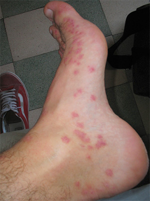 Traînée de piqûres de punaise sur le pied Traînée de piqûres de punaise sur le pied