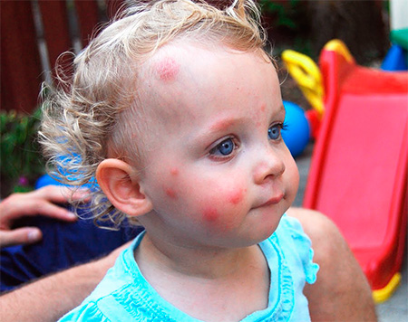 Piqûres de punaise sur le visage d'un enfant Piqûres de punaise sur le visage