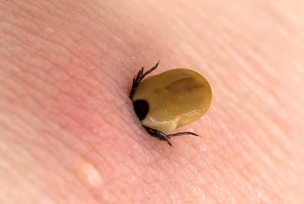 Infektion nach einem Zeckenbiss