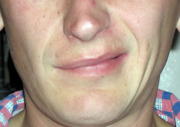 Gesichtsnervenentzündung nach Borreliose