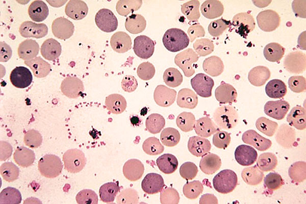 Babesiose im Blut