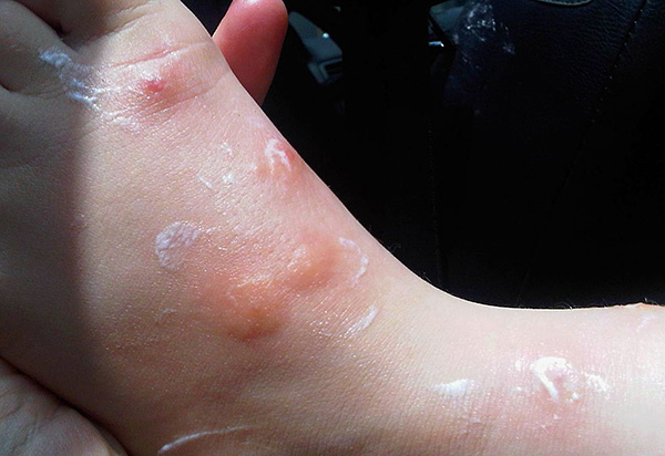 Piqûres de punaises de lit sur la jambe d'un enfant Piqûres de punaises de lit sur la jambe d'un enfant