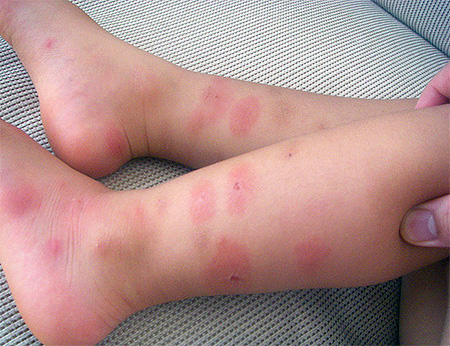 Piqûres de punaises sur les jambes d’un enfant Piqûres de punaises sur les jambes d’un enfant