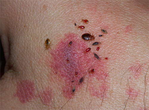 Punaises de lit et leurs larves sur la peau humaine Punaises de lit et leurs larves sur la peau humaine
