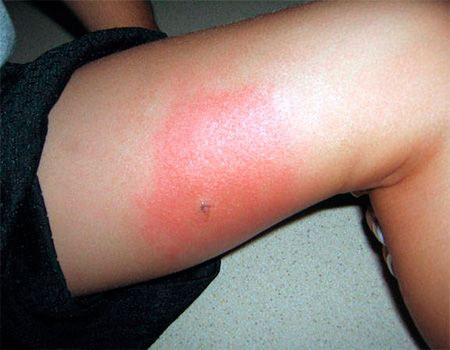 Exemple typique d'allergie à une piqûre d'insecte Allergie à la piqûre d'insecte