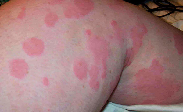 Allergie auf einen Zeckenbiss