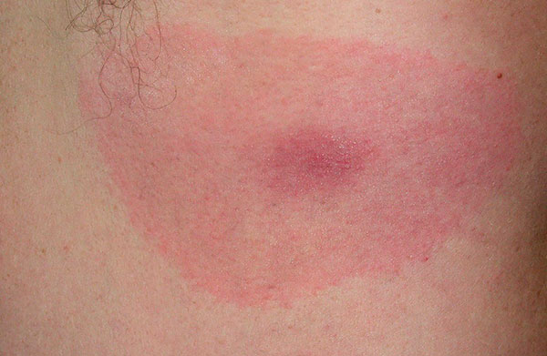 Erythem bei Lyme-Borreliose