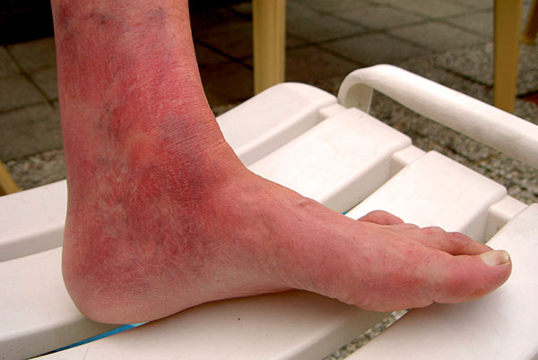 Gelenkschädigung bei chronischer Borreliose