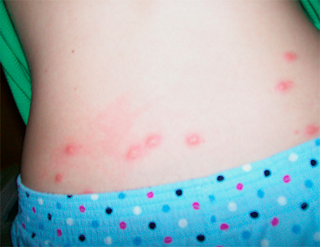 Piqûres de punaise sur le dos d'un enfant Piqûres de punaise sur le dos d'un enfant